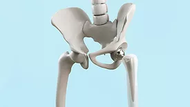 Hip replacement