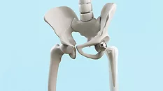 Hip replacement