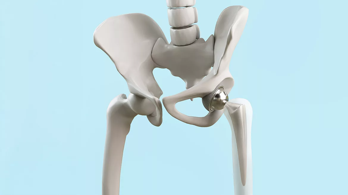 Default Medical Device Coatings 1492384925 Hip replacement